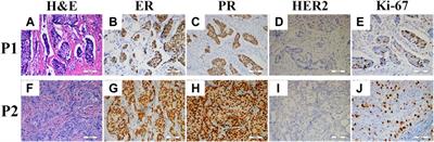 The Prognostic Value of Retraction Clefts in Chinese Invasive Breast Cancer Patients